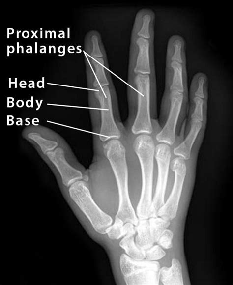 Proximal Phalanx: Definition, Location, Anatomy, Diagram