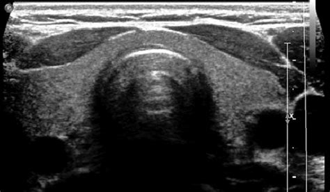 Thyroid Ultrasound Measurements