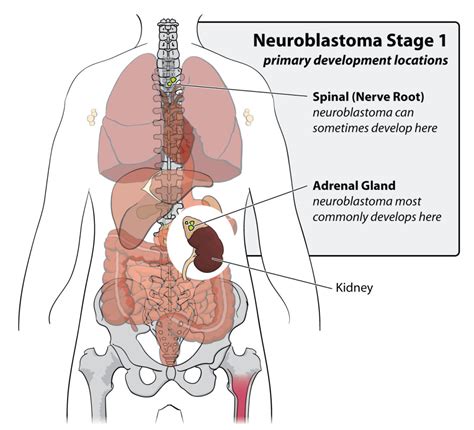 Neuroblastoma Childhood Cancer : Causes, Risk Factors, and Prevention