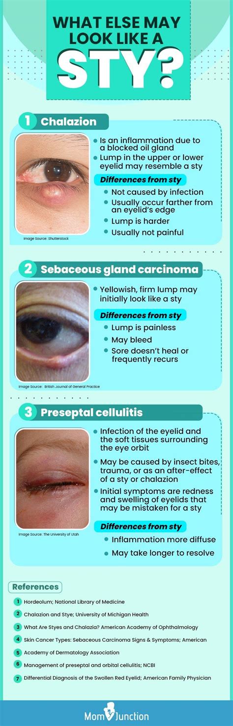 Stye Symptoms Treatment And Prevention