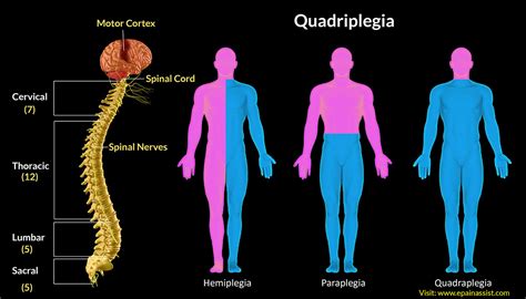 Know About Quadriplegia