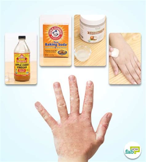 How to Get Rid of Fungal Infection (KILL the Fungus Naturally) | Fab How