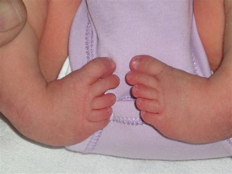 Talipes equinovarus - Types, Symptoms, Causes and Treatment