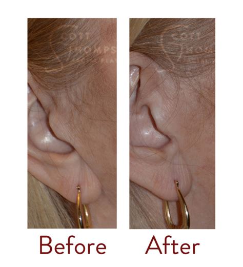 Facelift Scar Information from Utah Facial Plastics | SLC Utah