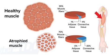 How to Fight Muscle Atrophy After Injury: A Personal Trainer’s Guide