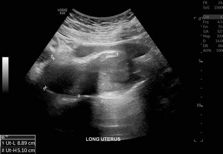 Tubo-ovarian abscess in a patient with bicornuate uterus | Radiology ...