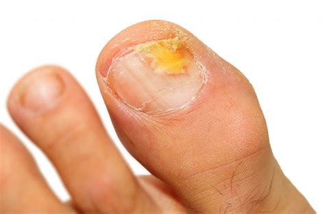 Fungal Toenails and Onychomycosis - The Foot and Ankle Clinic