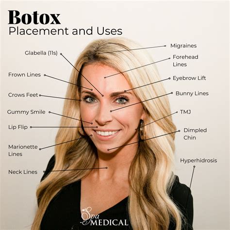 What is BOTOX® and How Does it Work? | Spa Medical