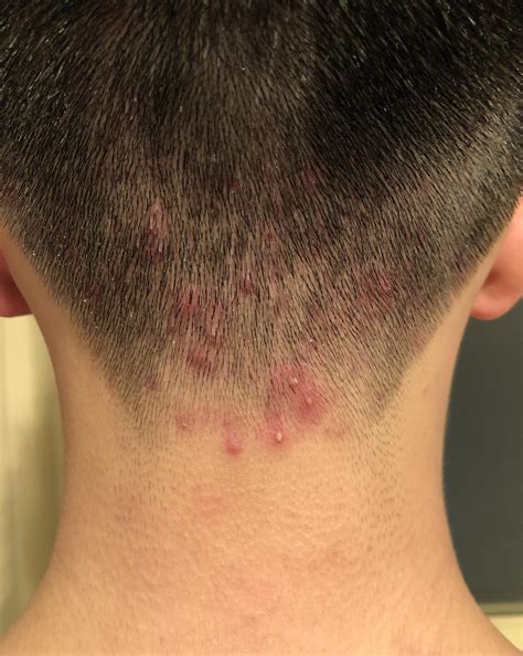 Is this Folliculitis? Also does anyone have any recommendations on ...