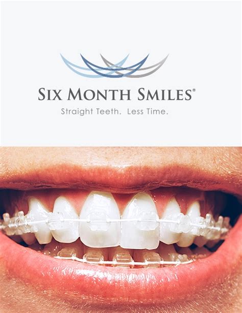 Six Month Smiles Essex | Clear Braces with 6 Month Smiles Hornchurch