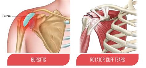 Rotator Cuff Tear Versus Bursitis | Treatment | Dr Ayyappan V Nair ...