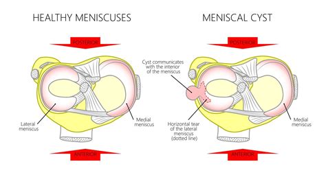 Meniscal Cyst Knee arthroscopy - Treatment | Dr A Theodorides | Knee ...