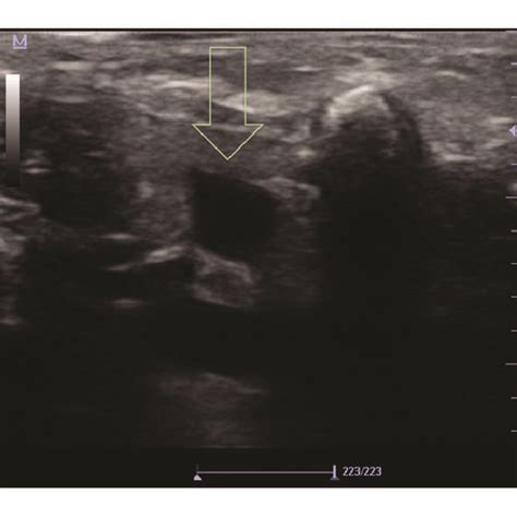 The ultrasound image of the subclavian vein. Yellow arrow is showing ...