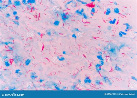 Mycobacterium tuberculosis stock image. Image of infection - 80362273