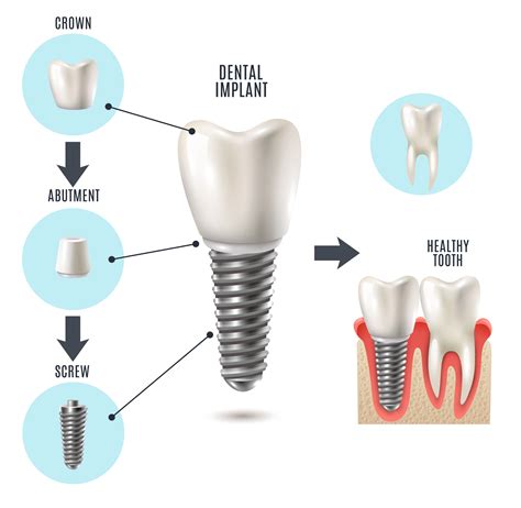 Dental Implants Cost Memphis, TN - Southern Dental Implant Center