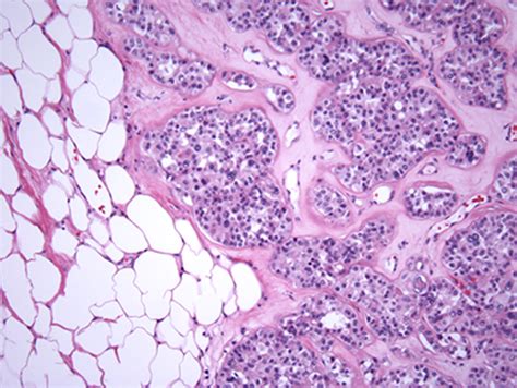 Kidney: Renal Oncocytoma