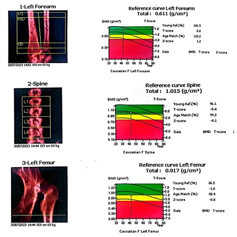 A DEXA scan was assessing the patient's bone density. The results ...