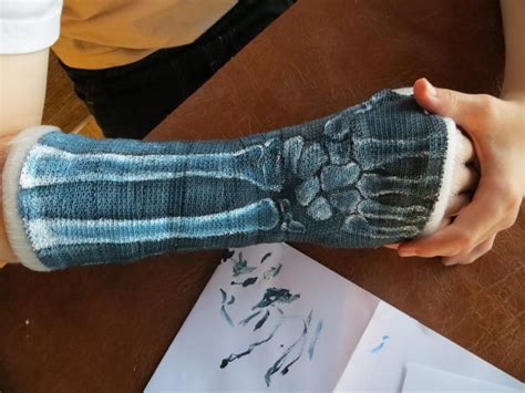 X-Ray Painted Cast | Yeso en el brazo, Pintura en yeso, Brazos