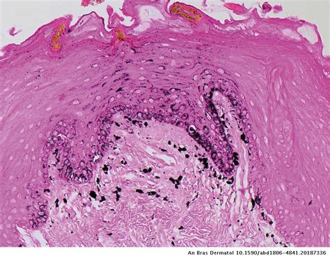 Lingual melanotic macule – the first case report in an adult patient ...