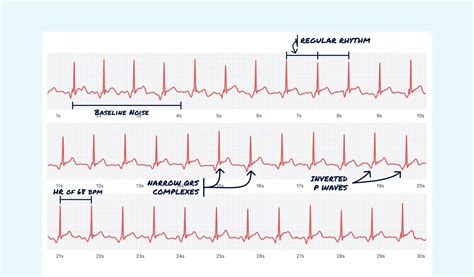 Junctional Rhythm Vs. Supraventricular Tachycardia (Non-Sustained) on ...