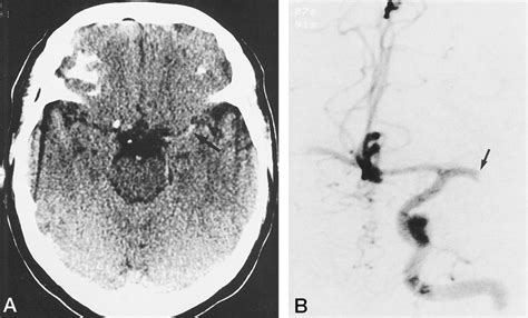 A, Early CT scan shows a hyperdense MCA sign (arrow) on the left 120 ...