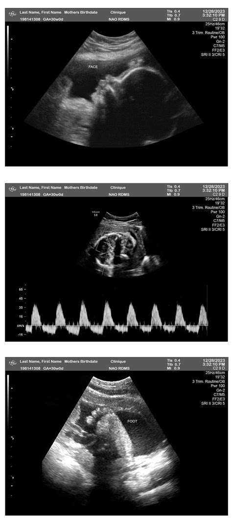 30 Weeks Ultrasound 3-Fetuses - Ultrasounds