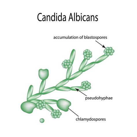 Candidiasis Guide: Causes, Symptoms and Treatment Options | All things here