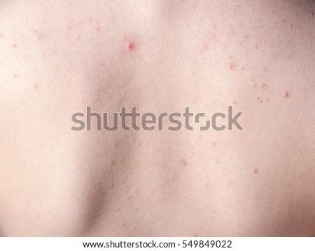 Hives Severe Allergic Reaction Stock Photo 4206169 - Shutterstock