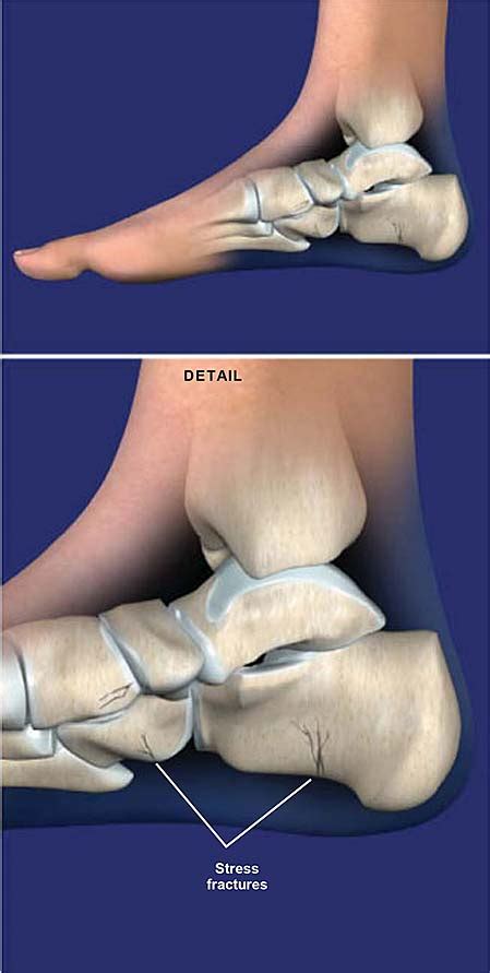 Stress Fractures of the Foot and Ankle | Central Coast Orthopedic ...