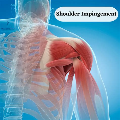 Shoulder Impingement Causes And Treatment – NBKomputer