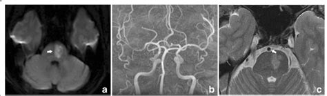 In a patient (50-59 year old) with acute isolated pontine infarction ...