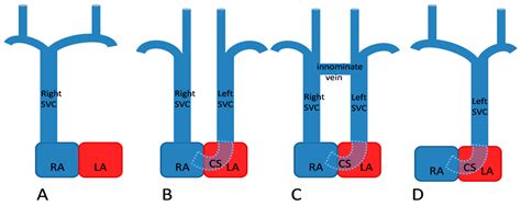 Diagnostics | Free Full-Text | Persistent Left Superior Vena Cava with ...