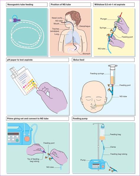 Enteral tube feeding procedure