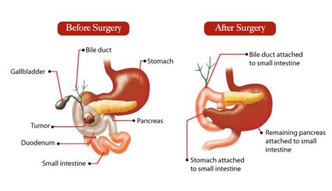 Pancreas Surgery