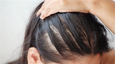 What Causes Hair Loss in Women? Causes & Treatments | Philip Kingsley