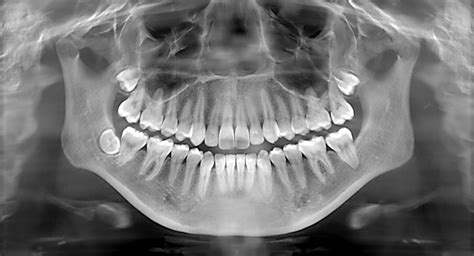 The Truth About Dental X-rays - Center for Restorative & Cosmetic Dentistry