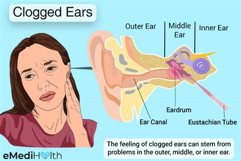 Clogged Ears: Causes, Symptoms, and Treatment Options