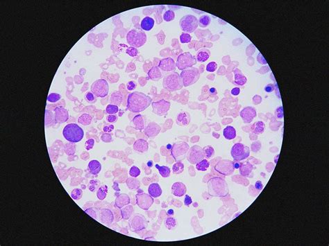 Acute myeloid leukemia (AML) morphology: What to know