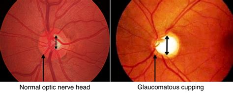 Glaucoma Tests and Diagnosis - Glaucoma Associates of Texas