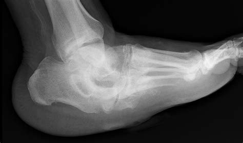 Charcot Joint Knee