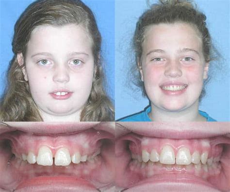 Overbite Before and After Braces - Top Pictures & More 2024 - BracesBoss