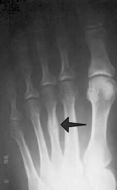 Metatarsal Stress Fractures – Treatment and Prevention | Foot & Ankle