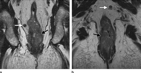 Mesorectal lymph node involvement. (a) Coronal high-resolution ...