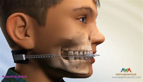 Overjet (AKA Overbite) Treatment by Headgear Orthodontic Device | ارتوسرجری