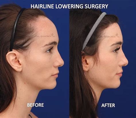 Hairline Lowering Surgery | Plastic Surgery