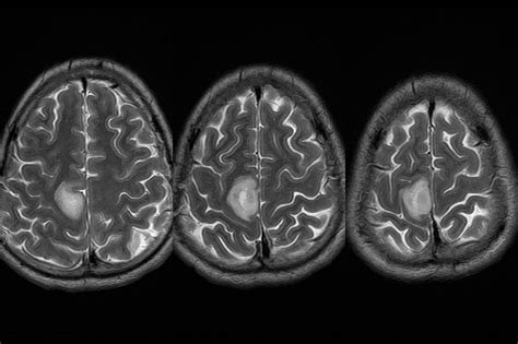 Superior Parietal Lobule Mri