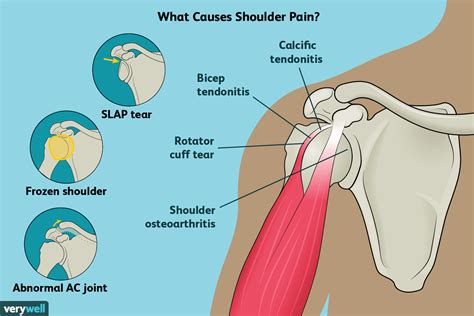 Shoulder Pain: Causes, Treatment, and When to See a Doctor