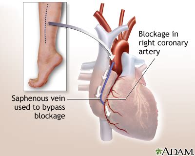 Heart Bypass Surgery