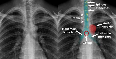 Endotracheal Tube Placement X Ray