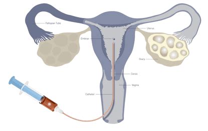 Frozen Embryo Transfer in Delhi by We Care Health Services